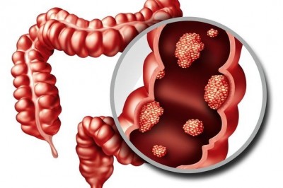 Kalın Bağırsak Kanserine Engel Olmanın #7 Yolu