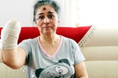 Güneşin Erittiği Kadın, Gün Geçtikçe Vücudundan Bir Parça Kaybediyor