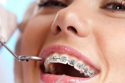 Diş Teli Dişlerimizi Nasıl Düzeltiyor?