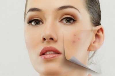 Akne İçin Ne Yapmak Gerekir?