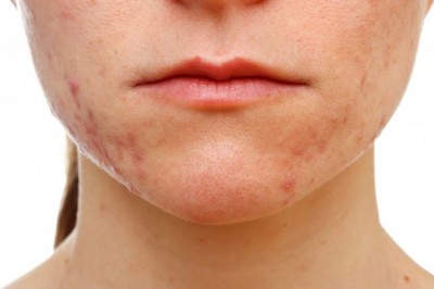 Cildinizi ‘maskne’ye karşı korumanız mümkün