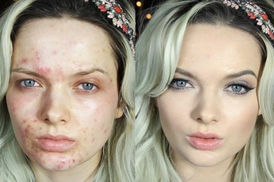 Sivilce izleri kabusunuz olmasın