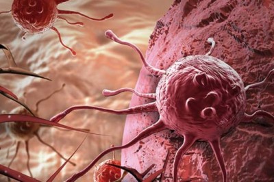 Teşhisinde Geç Kalmaktan Korkacağınız Kanser Hakkında Bilgiler