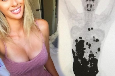 Kanser Taramasını Paylaşıp Benim Gibi Olmayın Dedi!