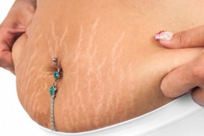 Vücut Çatlaklarından Korunma ve Kurtulma Yolları 