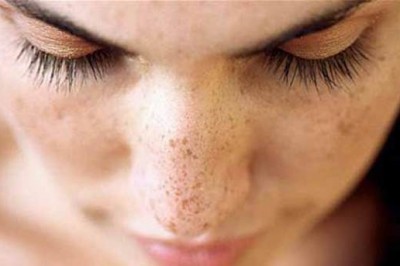 Kış Güneşinin Cilt Lekesi Yaptığını Biliyor Muydunuz?