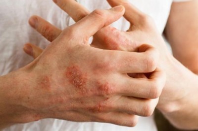 Egzama'nın Tetikleyicisi Soğuk Havalar